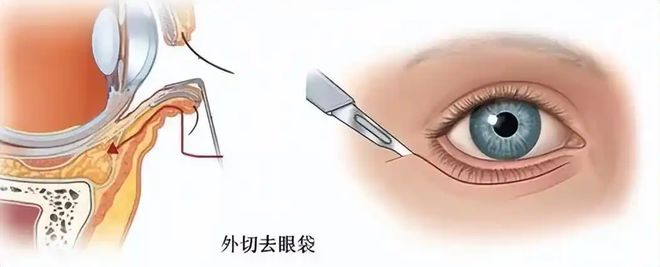 技术？拉皮手术面部提升无锡苏州杭州OG真人平台去除眼袋有什么比较好的(图2)